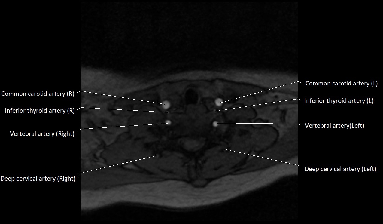Carotid artery anatomy axial 3T image 57.jpg